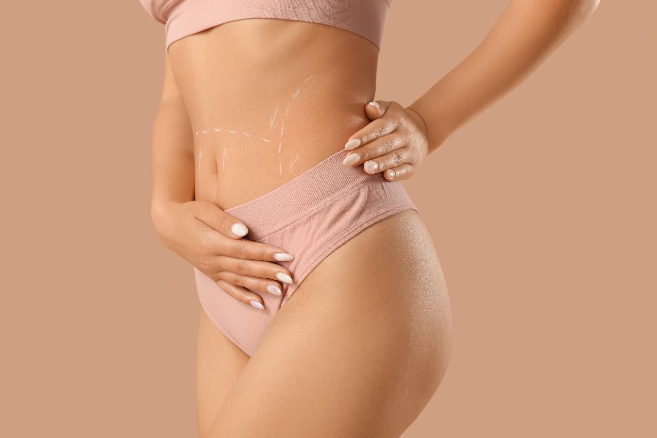 Close-up of a woman in underwear with marked abdomen showing areas for tummy tuck and abdominoplasty surgery.