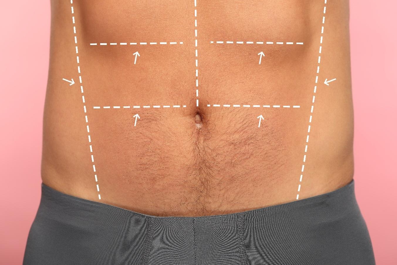 Man’s abdomen with surgical markings for male tummy tuck and abdominoplasty, close-up view against pink background.